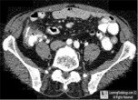 Bowel Perforation chicken bone
